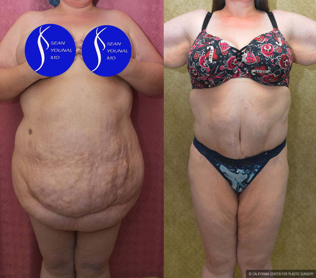 Tummy Tuck (Abdominoplasty) Super Plus Size Before & After Patient #13396