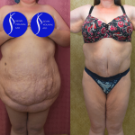 Tummy Tuck (Abdominoplasty) Super Plus Size Before & After Patient #13396