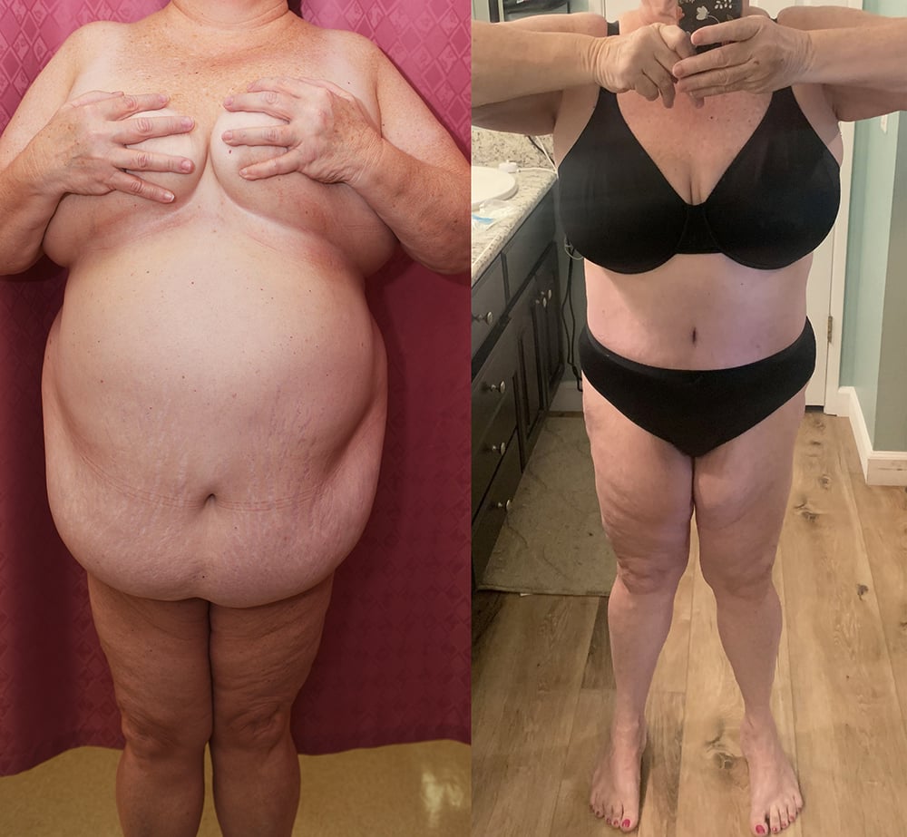 Liposuction Abdomen Plus Size Before & After Patient #13397