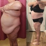 Liposuction Abdomen Plus Size Before & After Patient #13397