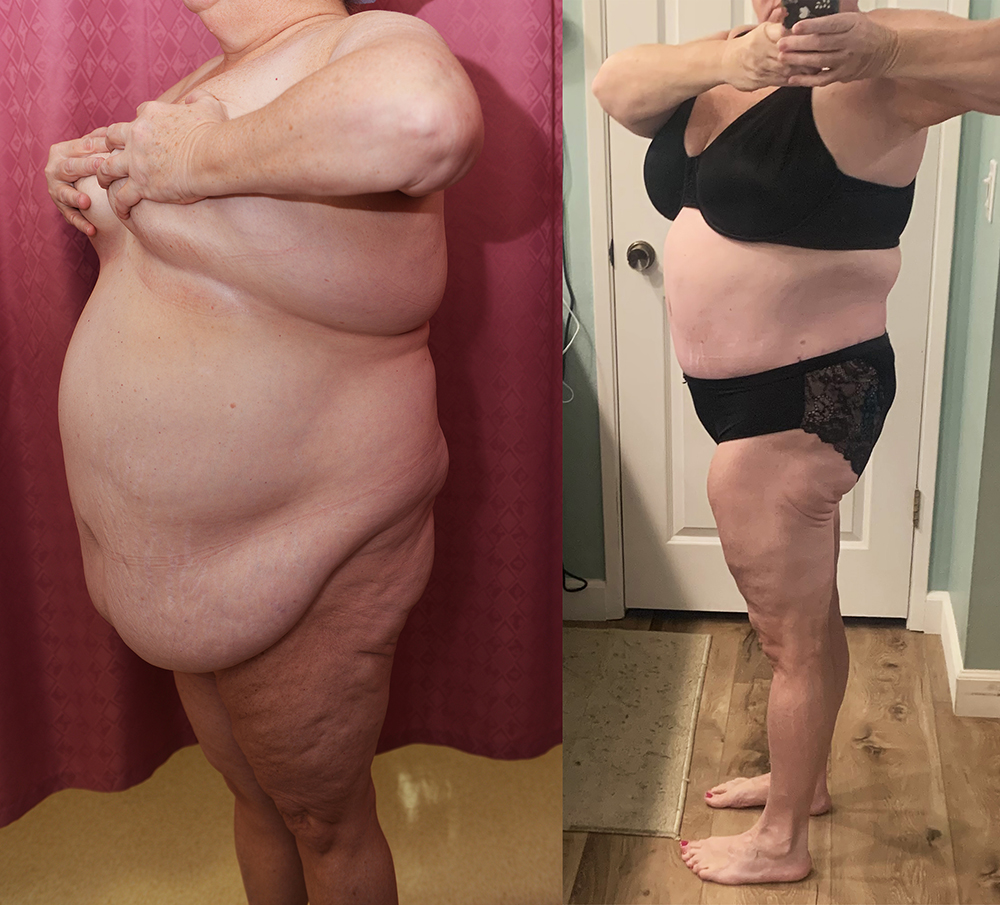 Liposuction Abdomen Plus Size Before & After Patient #13397