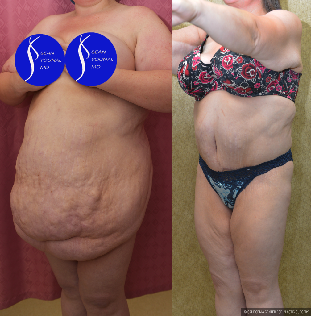 Tummy Tuck (Abdominoplasty) Super Plus Size Before & After Patient #13396