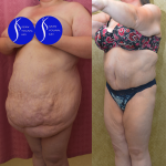 Tummy Tuck (Abdominoplasty) Super Plus Size Before & After Patient #13396