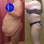 Tummy Tuck (Abdominoplasty) Super Plus Size Before & After Patient #13396