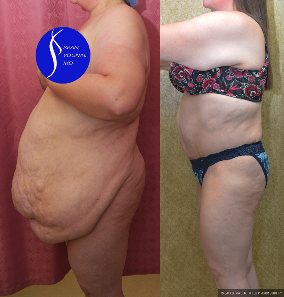 Tummy Tuck (Abdominoplasty) Super Plus Size Before & After Patient #13396