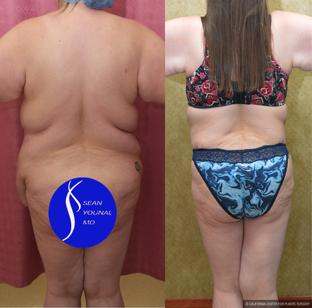 Tummy Tuck (Abdominoplasty) Super Plus Size Before & After Patient #13396