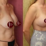 Breast Lift (Mastopexy) Before & After Patient #13390