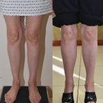 Calf Augmentation Before & After Patient #13391