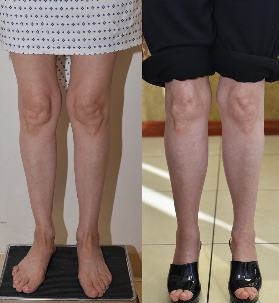 Calf Augmentation Before & After Patient #13391