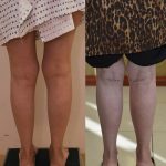 Calf Augmentation Before & After Patient #13391