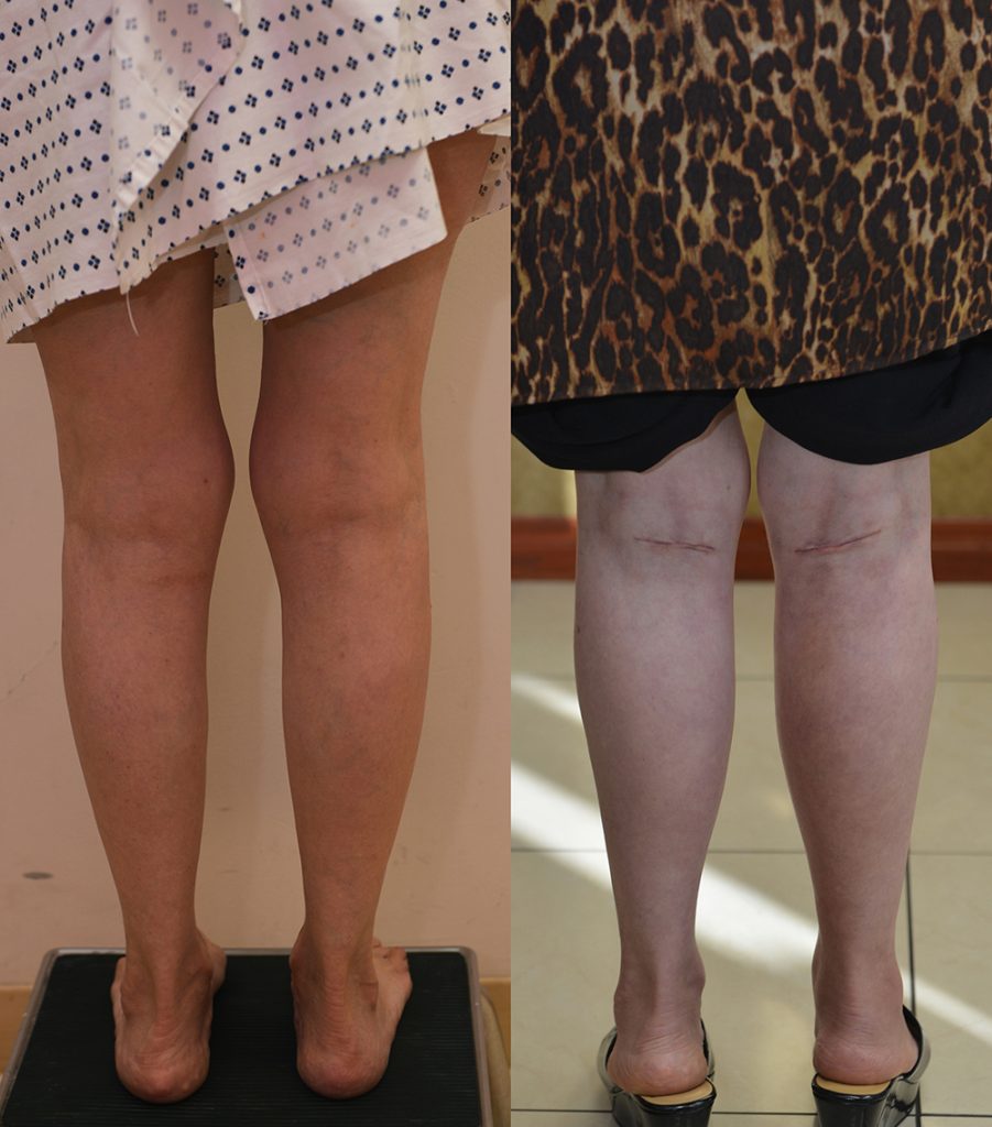 Calf Augmentation Before & After Patient #13391
