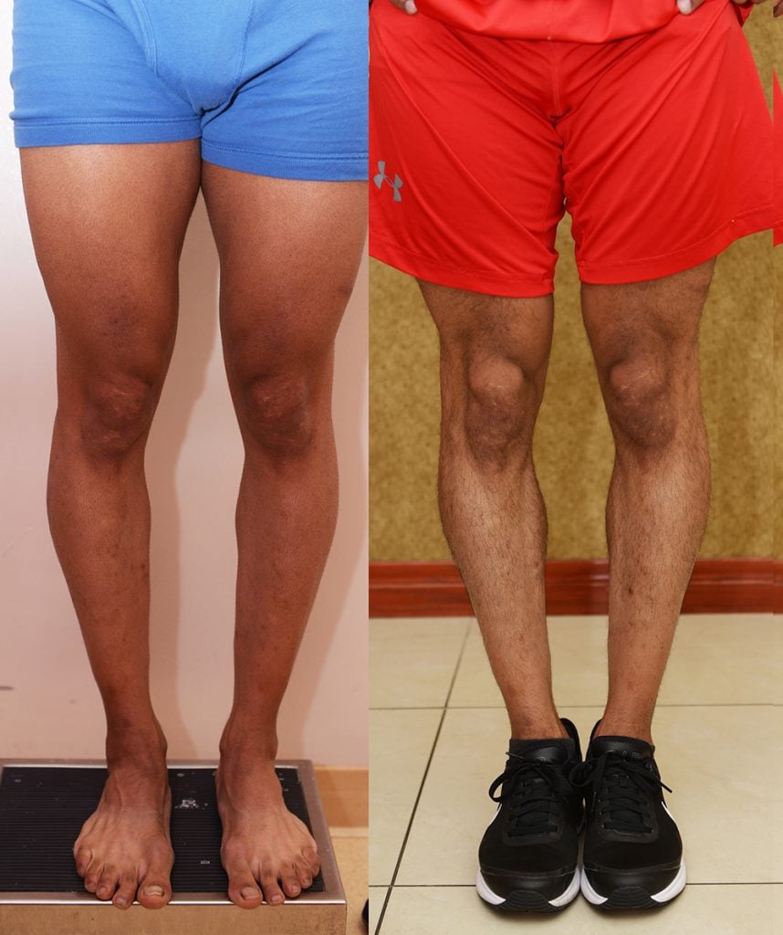 Calf Augmentation Before & After Patient #13392