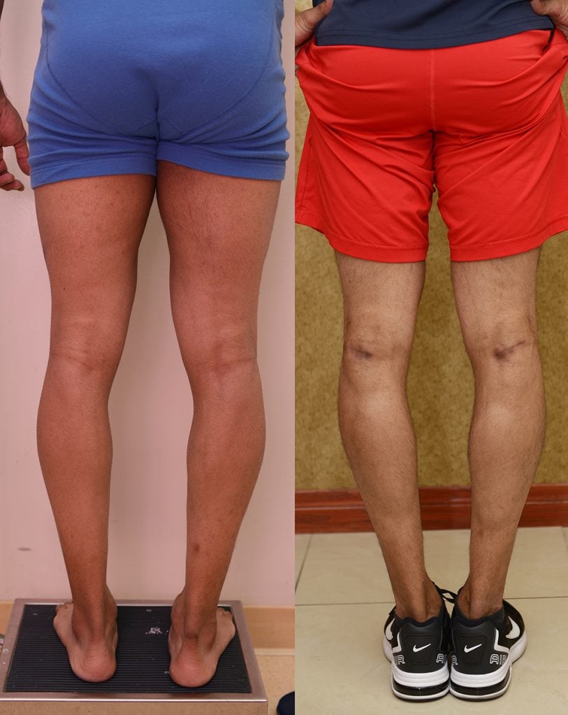 Calf Augmentation Before & After Patient #13392