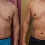 Male gynecomastia (breast) reduction Before & After Patient #13393