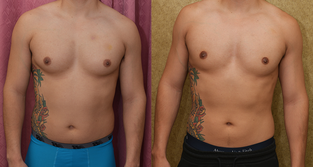 Male gynecomastia (breast) reduction Before & After Patient #13393