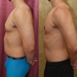 Male gynecomastia (breast) reduction Before & After Patient #13393