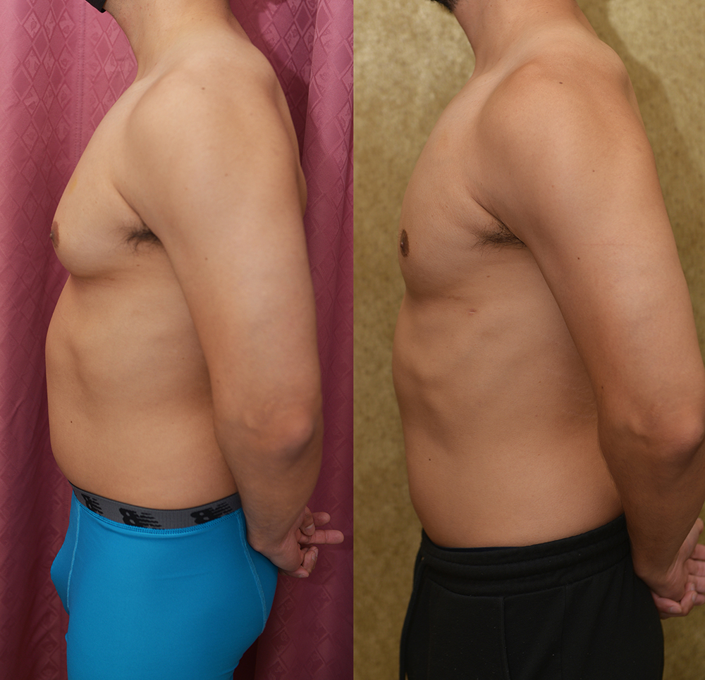 Male gynecomastia (breast) reduction Before & After Patient #13393