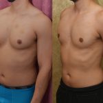 Male gynecomastia (breast) reduction Before & After Patient #13393