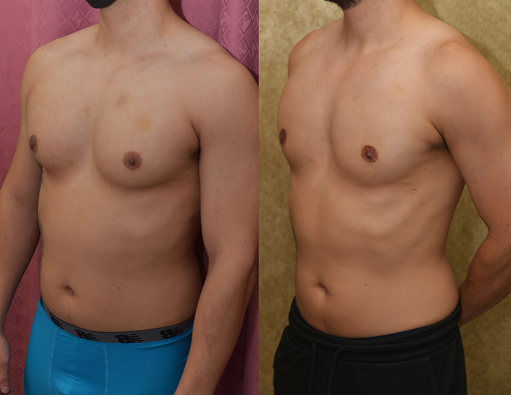 Male gynecomastia (breast) reduction Before & After Patient #13393