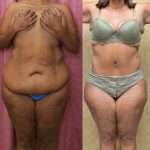 African American Tummy Tuck (Abdominoplasty) Before & After Patient #13394