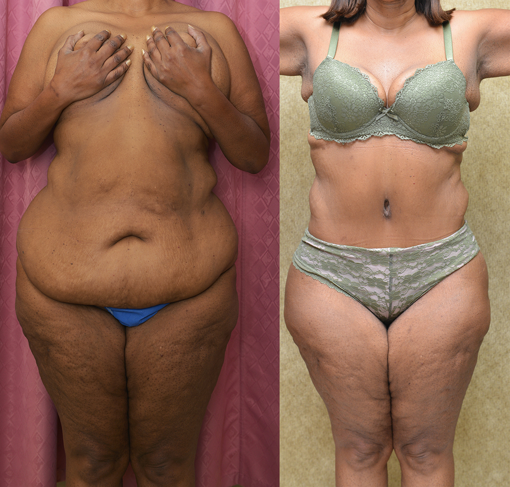 African American Tummy Tuck (Abdominoplasty) Before & After Patient #13394