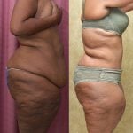 African American Tummy Tuck (Abdominoplasty) Before & After Patient #13394