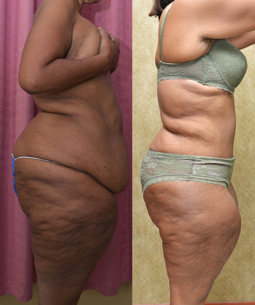 African American Tummy Tuck (Abdominoplasty) Before & After Patient #13394