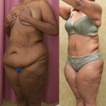 African American Tummy Tuck (Abdominoplasty) Before & After Patient #13394