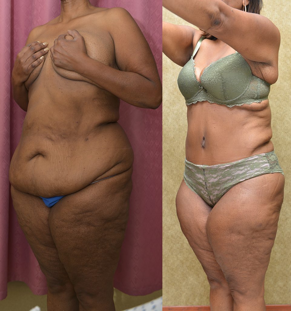 African American Tummy Tuck (Abdominoplasty) Before & After Patient #13394