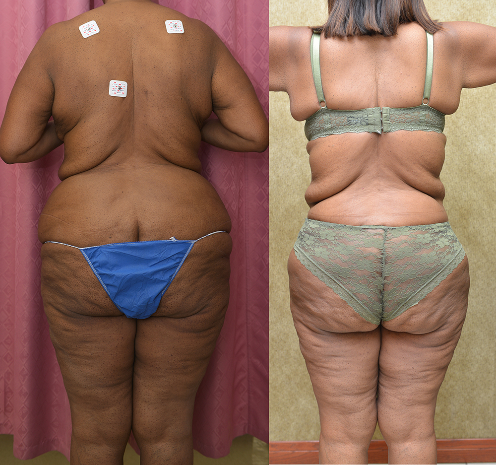African American Tummy Tuck (Abdominoplasty) Before & After Patient #13394