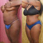 African American Tummy Tuck (Abdominoplasty) Before & After Patient #13395
