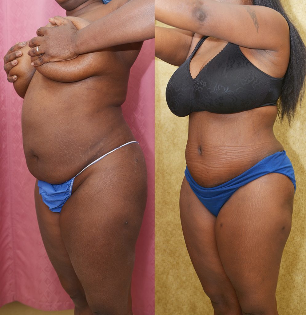 African American Tummy Tuck (Abdominoplasty) Before & After Patient #13395