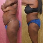 African American Tummy Tuck (Abdominoplasty) Before & After Patient #13395