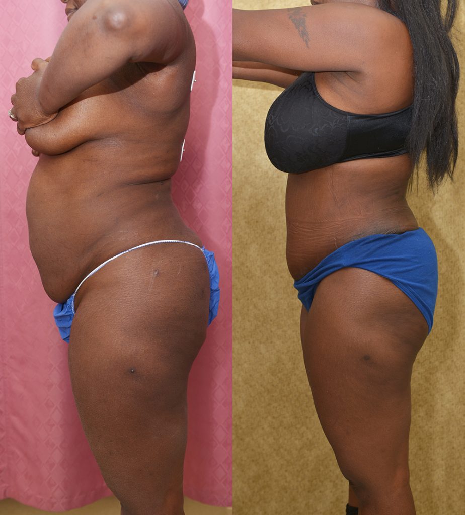 African American Tummy Tuck (Abdominoplasty) Before & After Patient #13395