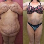 Tummy Tuck (Abdominoplasty) Super Plus Size Before & After Patient #13396