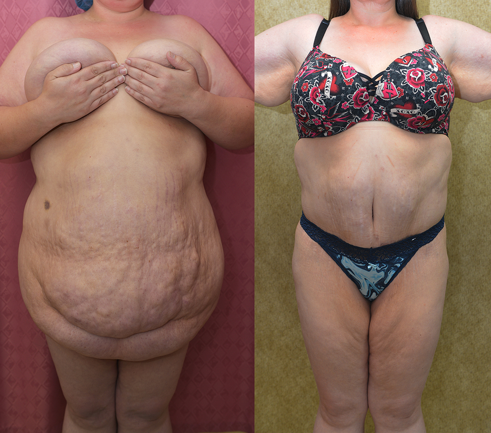 Tummy Tuck (Abdominoplasty) Super Plus Size Before & After Patient #13396