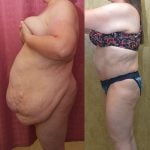 Tummy Tuck (Abdominoplasty) Super Plus Size Before & After Patient #13396