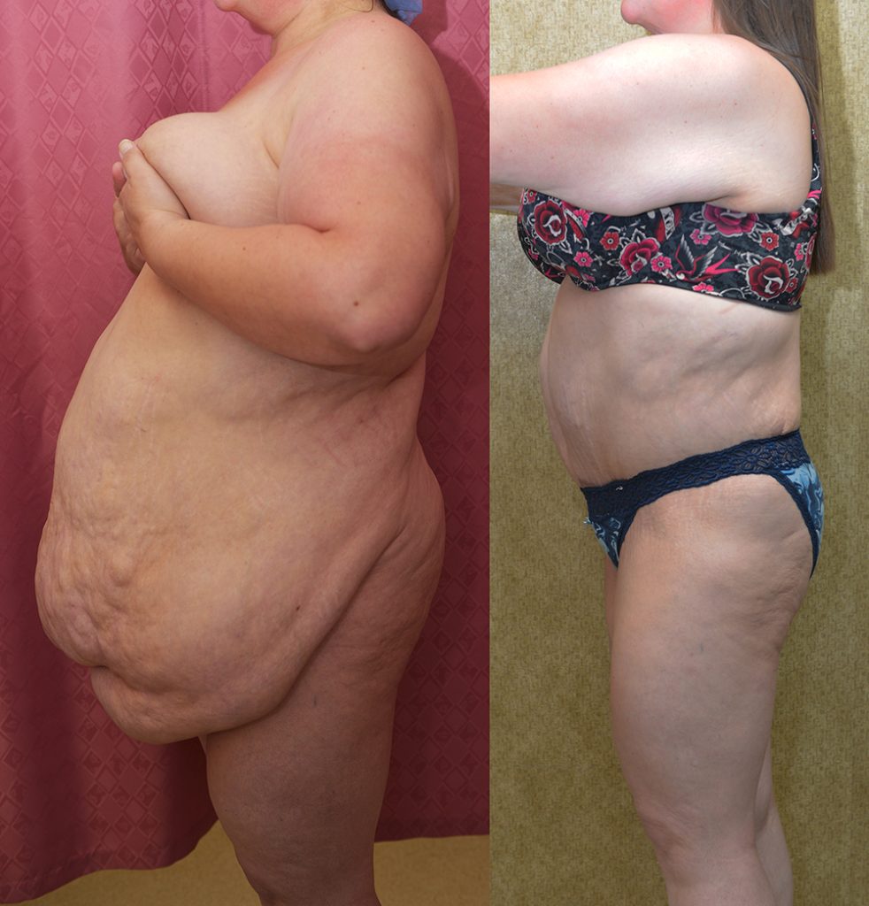Tummy Tuck (Abdominoplasty) Super Plus Size Before & After Patient #13396
