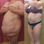 Tummy Tuck (Abdominoplasty) Super Plus Size Before & After Patient #13396