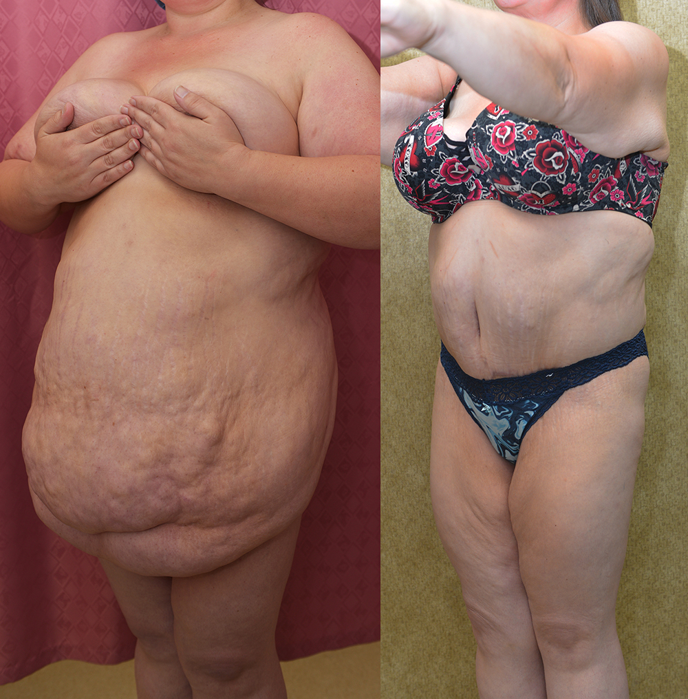 Tummy Tuck (Abdominoplasty) Super Plus Size Before & After Patient #13396