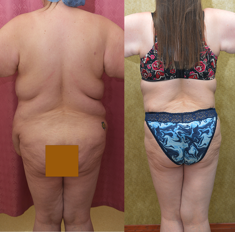 Tummy Tuck (Abdominoplasty) Super Plus Size Before & After Patient #13396