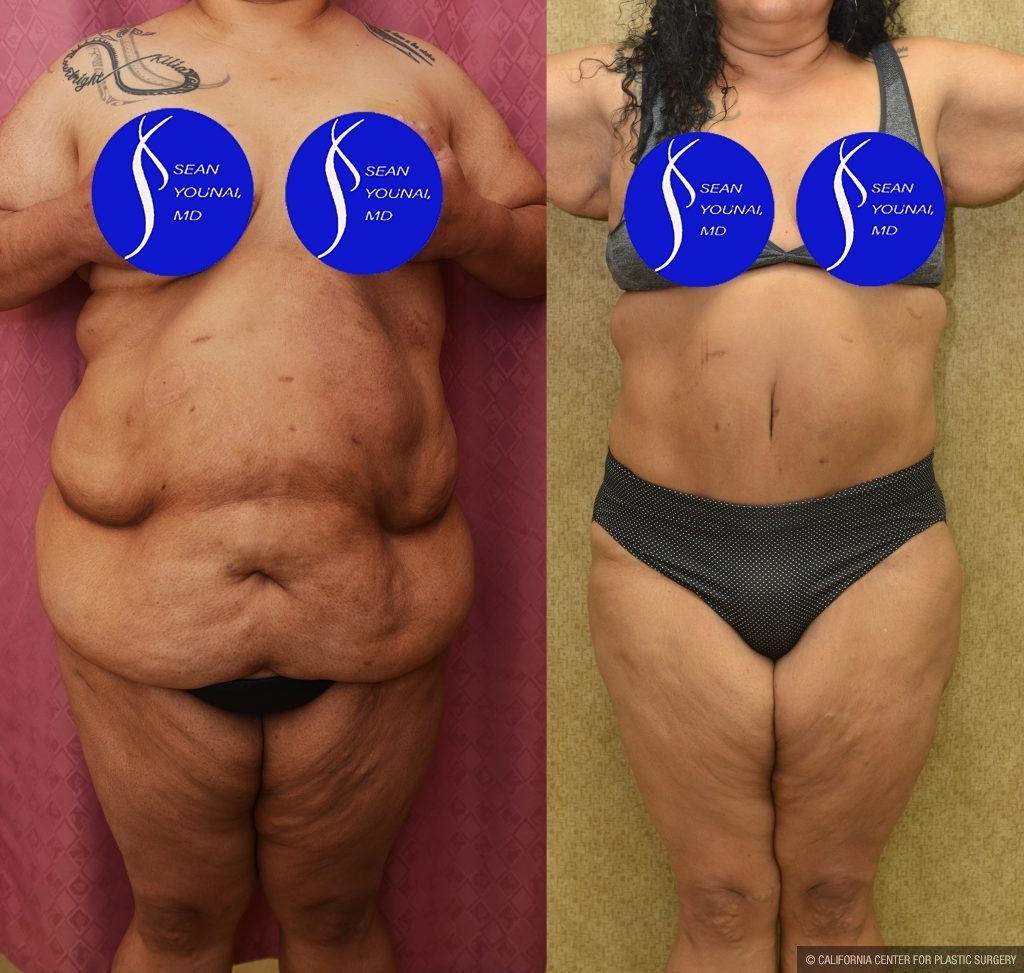 Tummy Tuck (Abdominoplasty) Super Plus Size Before & After Patient #13516