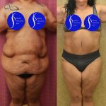 Tummy Tuck (Abdominoplasty) Super Plus Size Before & After Patient #13516