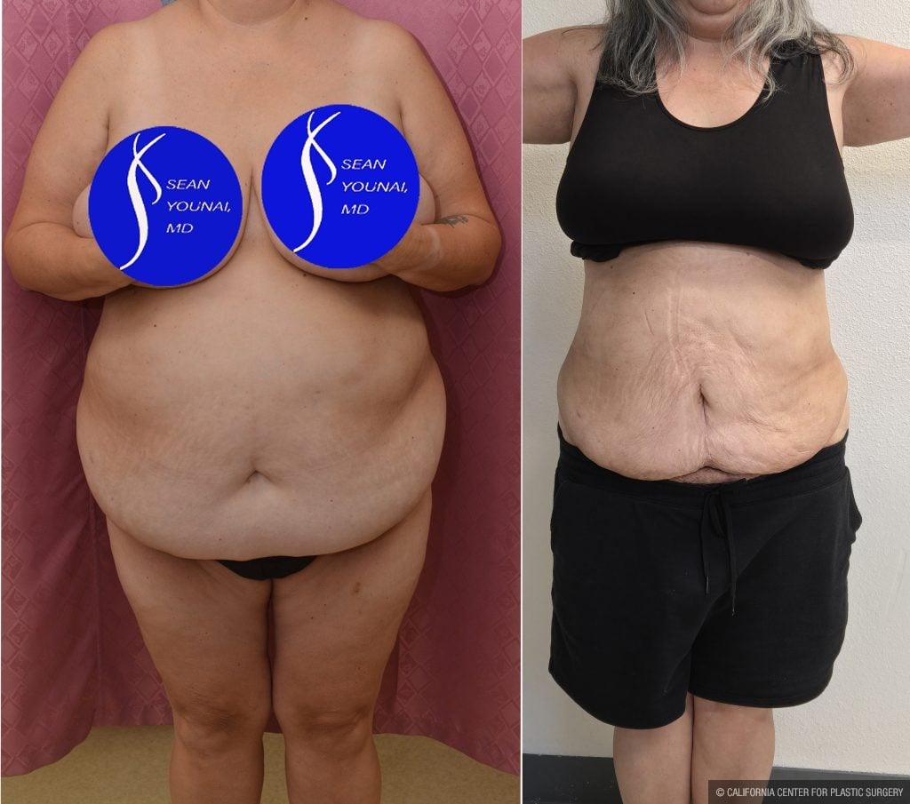 Liposuction Abdomen Plus Size Before & After Patient #13515