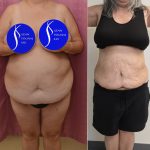 Liposuction Abdomen Plus Size Before & After Patient #13515
