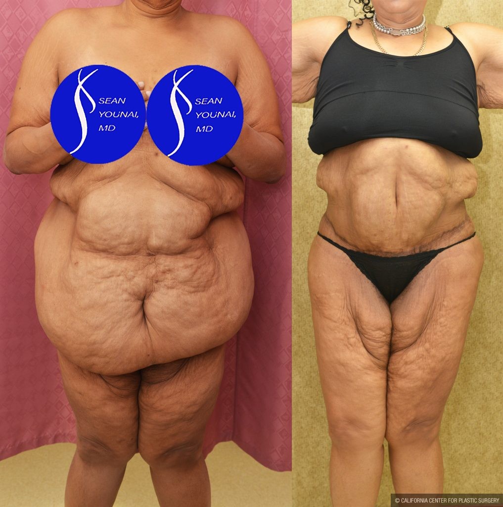 Tummy Tuck (Abdominoplasty) Super Plus Size Before & After Patient #13517