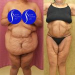 Tummy Tuck (Abdominoplasty) Super Plus Size Before & After Patient #13517