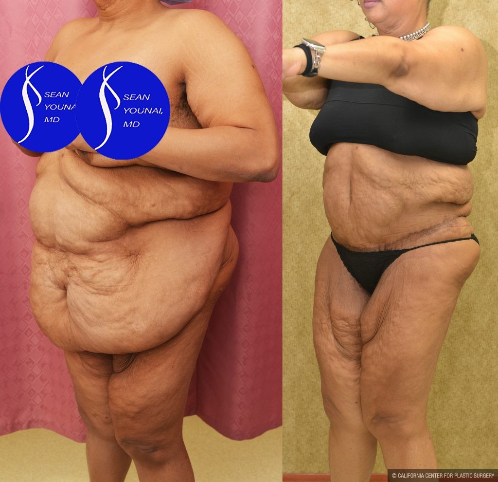 Tummy Tuck (Abdominoplasty) Super Plus Size Before & After Patient #13517