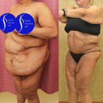 Tummy Tuck (Abdominoplasty) Super Plus Size Before & After Patient #13517
