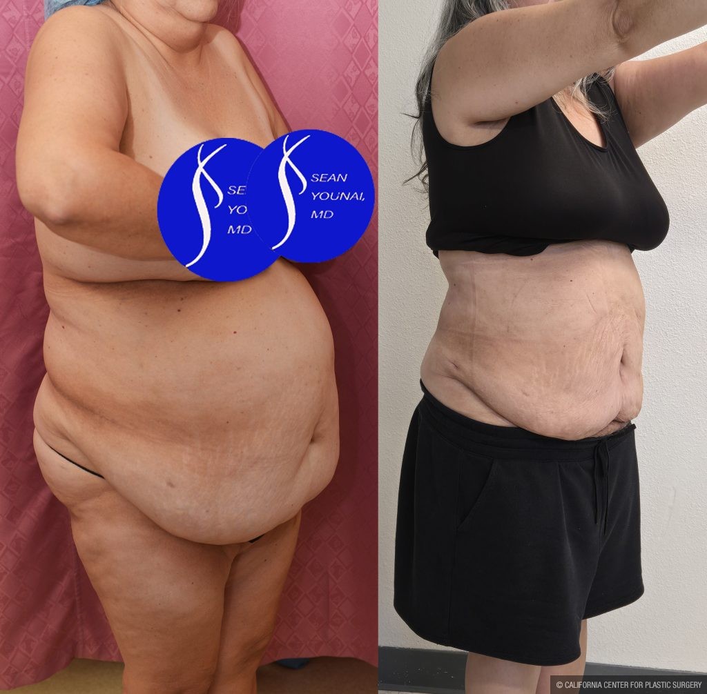 Liposuction Abdomen Plus Size Before & After Patient #13515